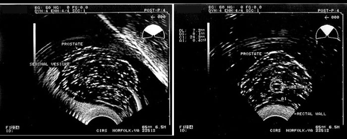 Prostate Seed Placement Ultrasound Training Phantom Cirs 053 I