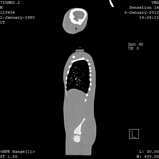 SPoRT CT Image 94