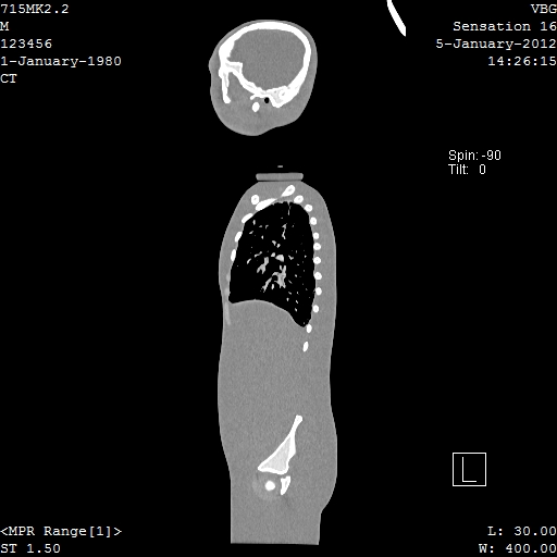 SPoRT CT Image 95