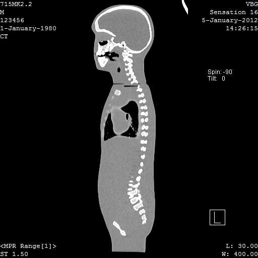 SPoRT CT Image 101